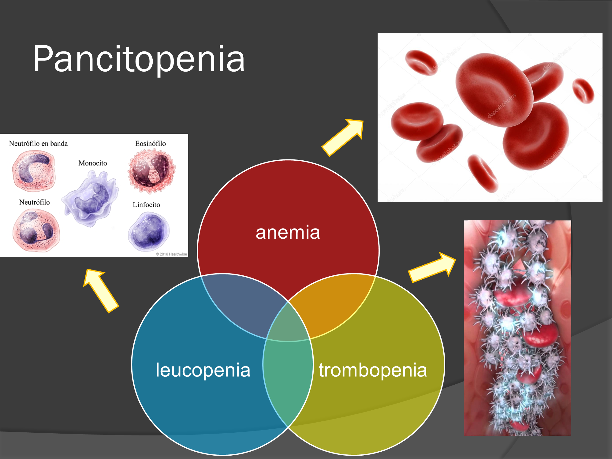 Hematología en un paciente celiaco por la Dra. Ana Arruga