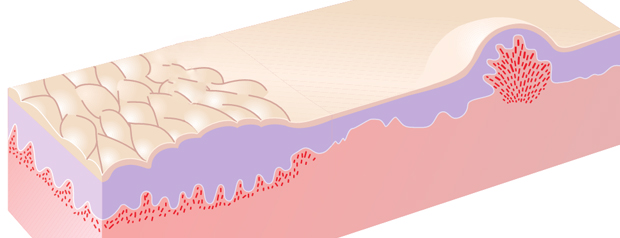 Dermatitis herpetiforme 