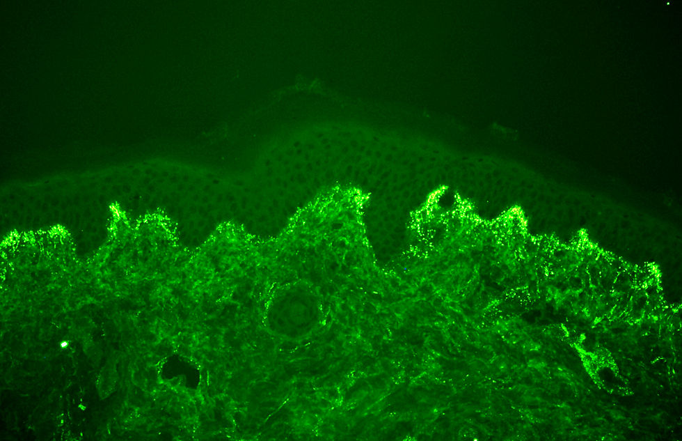 dermatitis herpetiforme